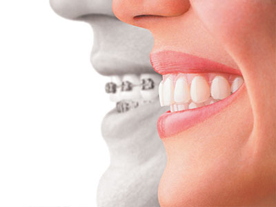 An advertisement featuring a smiling woman and a man s face superimposed to showcase dental implants.