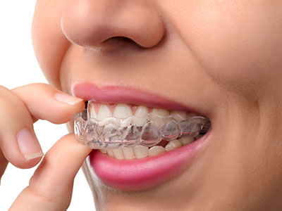 A person wearing a clear retainer with their teeth, holding it up to their mouth.