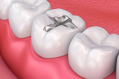 The image shows a close-up of a dental implant in the process of being inserted into a tooth gap, with visible teeth and gums.