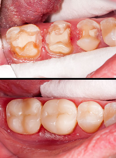 The image shows a close-up of a person s mouth with teeth that appear to be in poor condition, possibly requiring dental treatment.