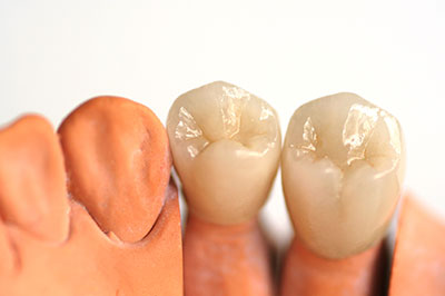 The image shows a set of artificial teeth with different shades and textures, likely for dental implant purposes.