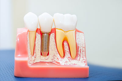 An image of a dental model with artificial teeth and roots, showcasing the process of implantation or restoration.