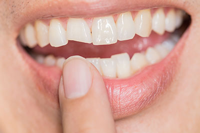 The image shows a close-up of a person s smiling mouth with white teeth, holding their finger near their lip to cover a small gap between the teeth.