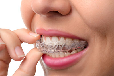 A woman with a clear orthodontic retainer in her mouth, holding it between her fingers.