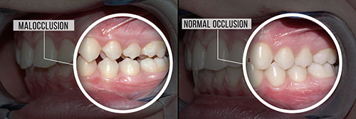 The image shows a side-by-side comparison of a person s teeth before and after dental treatment, with labels indicating the difference between normal occlusion and malocclusion.