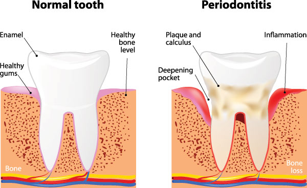 The image is a detailed medical illustration that shows the progression of gum disease from normal to periodontitis, highlighting the effects on tooth enamel, bone, and pockets within the gums.