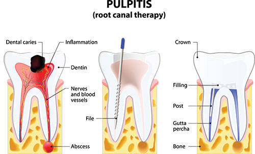 The image is a detailed medical illustration showing the structure of teeth and gums, highlighting dental caries and pulpitis with annotations indicating inflammation, infection, and potential treatment.