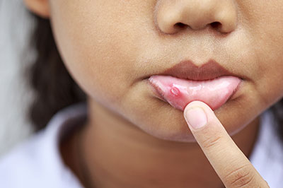 The image shows a close-up of a young person s face with an acne treatment applied to their skin.