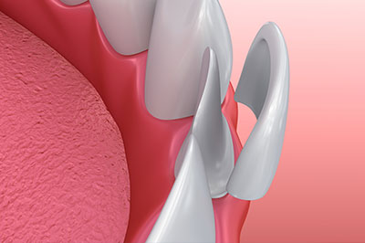 The image shows a close-up of a dental implant with a pink gum background, highlighting the implant s design and placement.