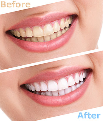 The image shows a woman with a wide smile displaying her teeth before and after a cosmetic dental treatment, likely a whitening procedure.