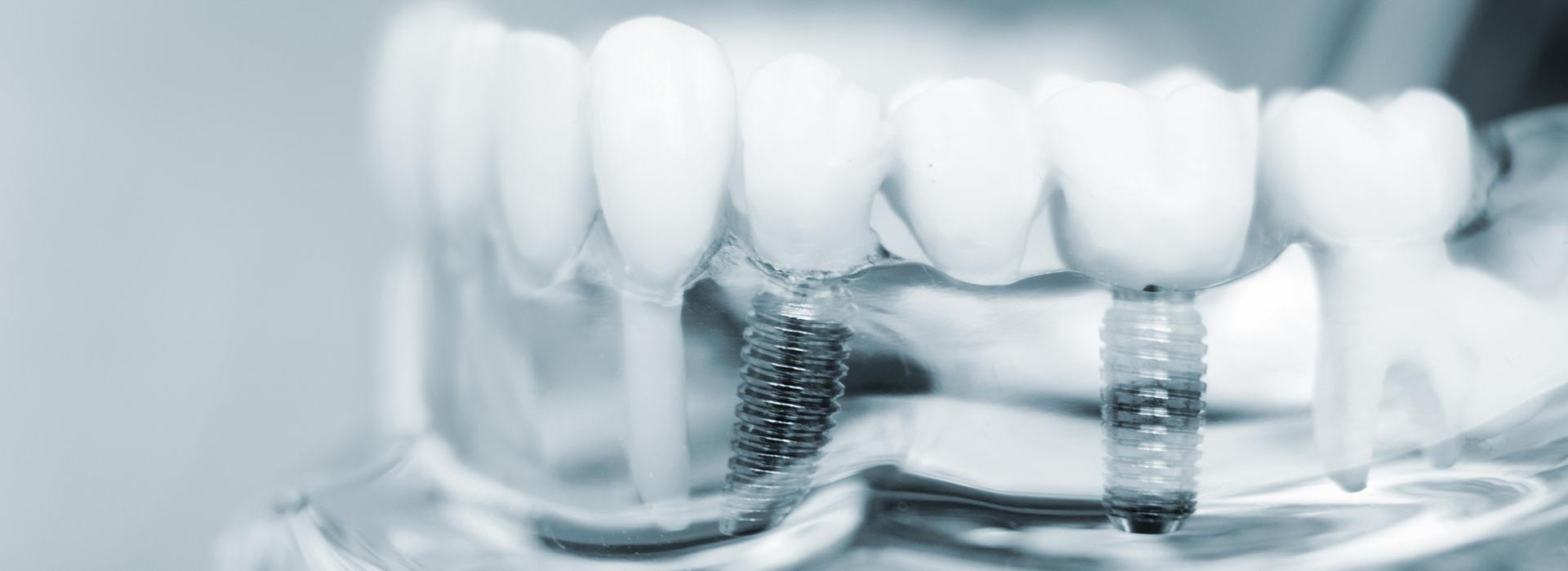 The image shows a close-up of multiple teeth with visible braces, set against a blurred background that appears to be an industrial or mechanical setting.