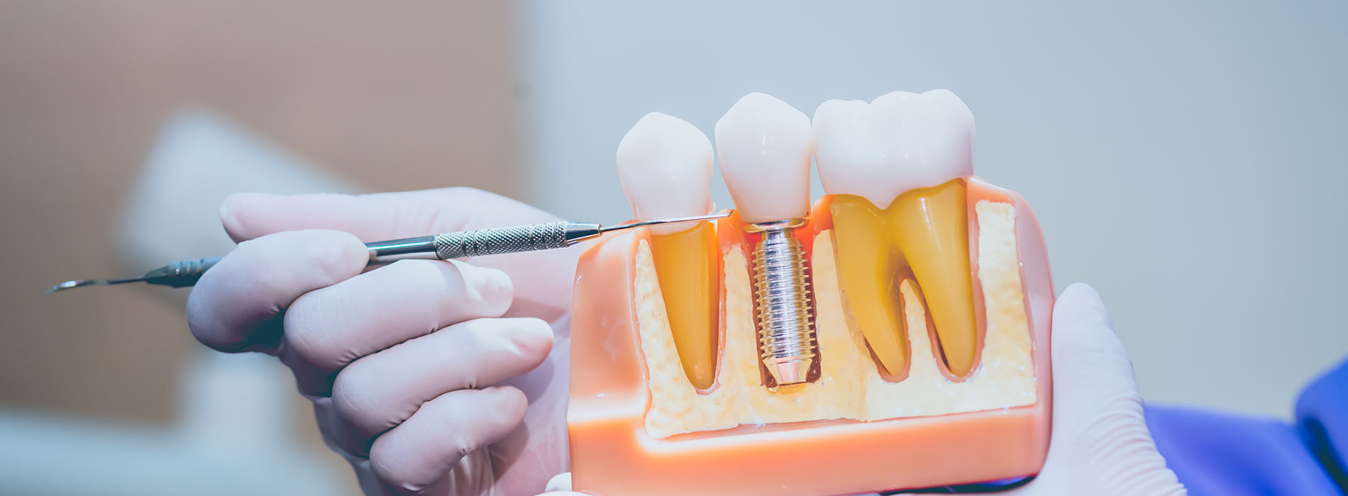 An image of a person holding a dental implant device with a tooth in it, ready for use.