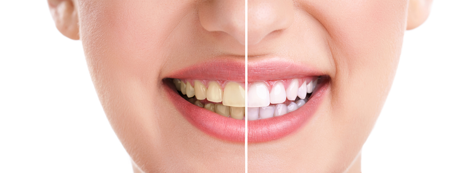 An image of a smiling woman with a visible dental treatment process in progress, showcasing the transformation from her natural smile to the enhanced one.