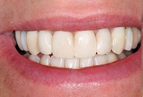 A smiling person showing a set of white teeth with a visible dental implant and gumline.