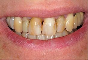 The image shows a close-up of a person s mouth with yellowed teeth and a partial smile, set against a neutral background.